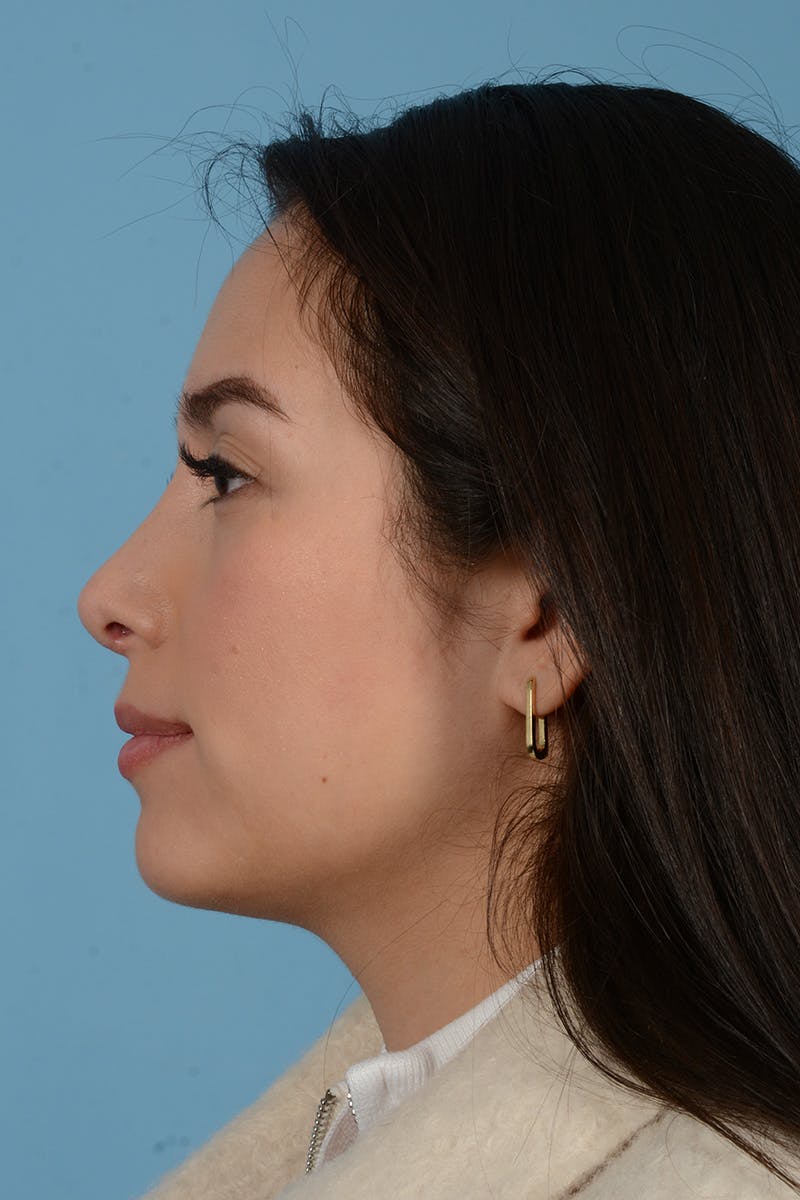 Rhinoplasty Before & After Gallery - Patient 206440 - Image 8