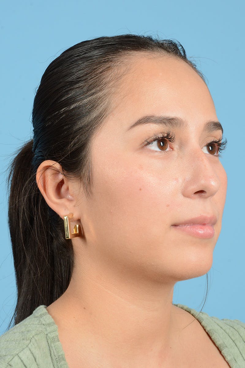 Rhinoplasty Before & After Gallery - Patient 206440 - Image 9
