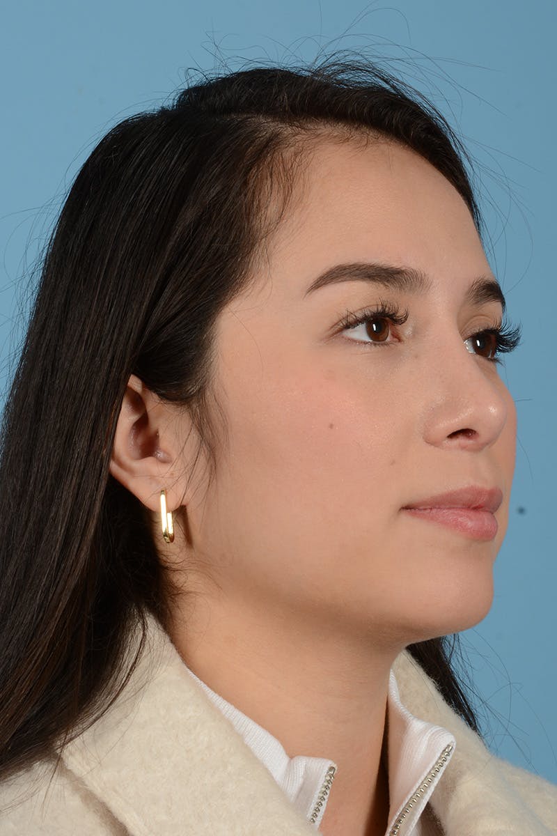 Rhinoplasty Before & After Gallery - Patient 206440 - Image 10