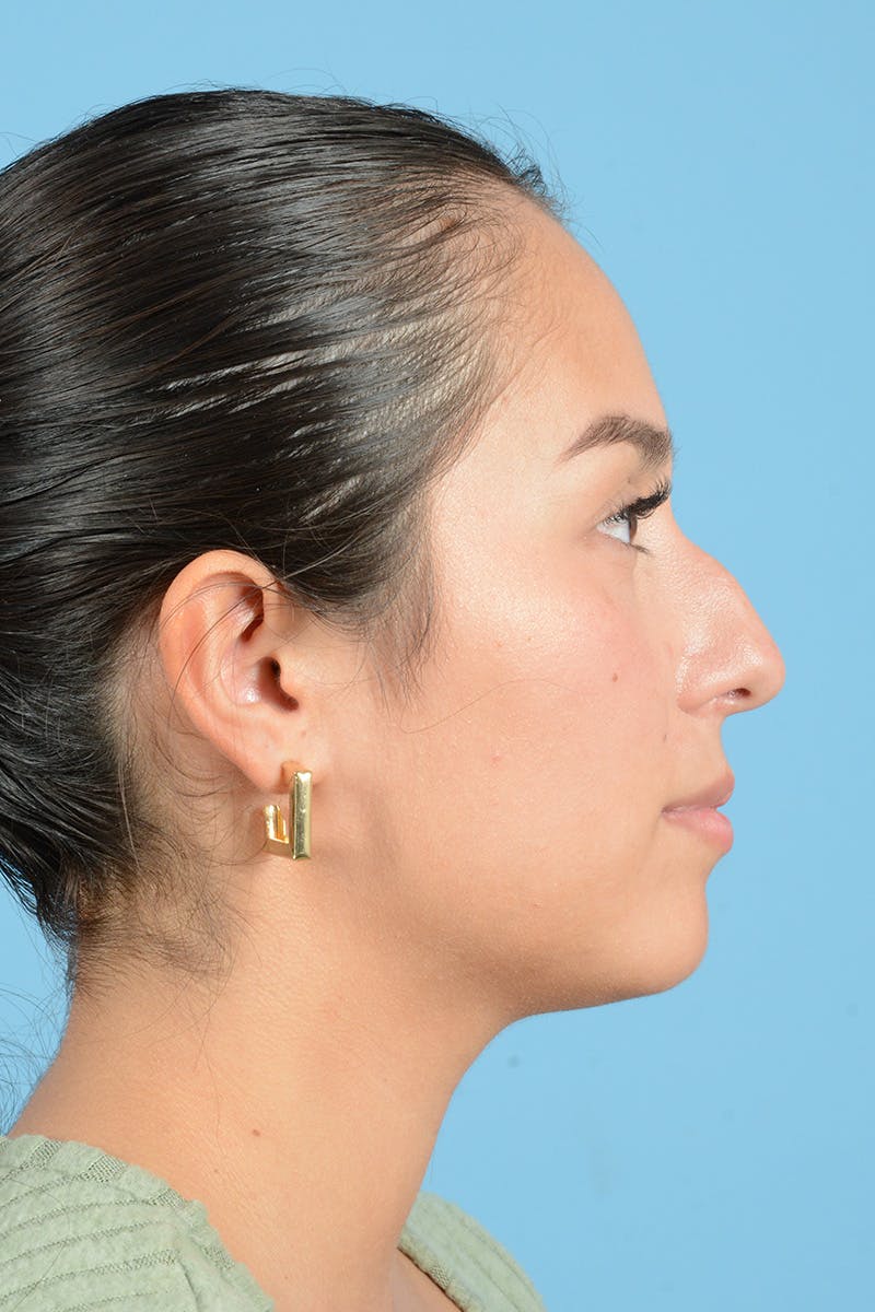 Rhinoplasty Before & After Gallery - Patient 206440 - Image 11