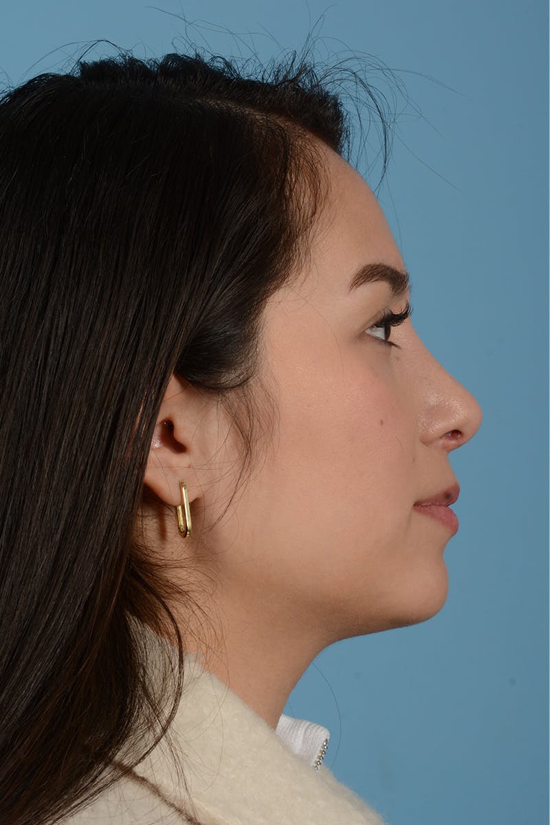 Rhinoplasty Before & After Gallery - Patient 206440 - Image 12