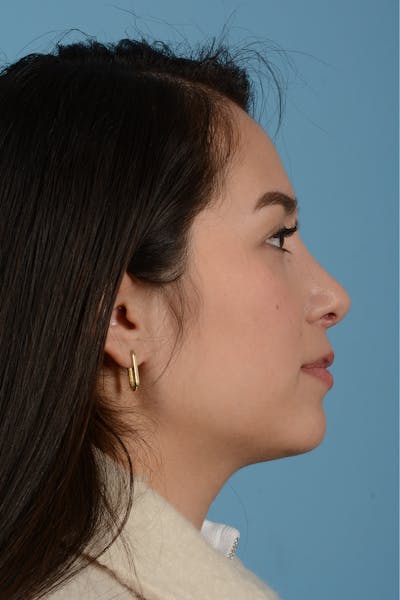 Rhinoplasty Before & After Gallery - Patient 206440 - Image 12