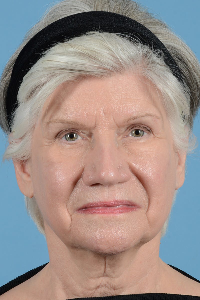 Facial Augmentation Before & After Gallery - Patient 291977 - Image 1