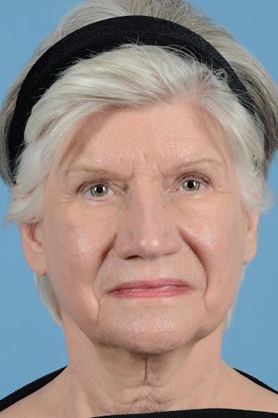 Facial Augmentation Before & After Gallery - Patient 291977 - Image 1