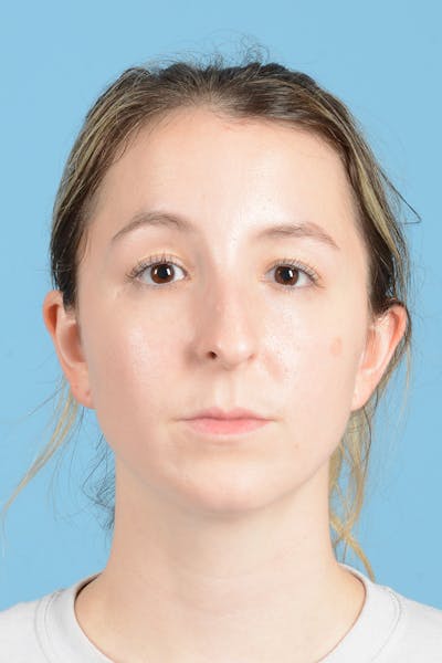 Rhinoplasty Before & After Gallery - Patient 356875 - Image 1