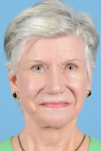 Facial Augmentation Before & After Gallery - Patient 291977 - Image 2