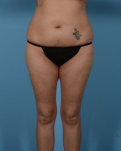 Mommy Makeover Before & After Gallery - Patient 192022 - Image 1