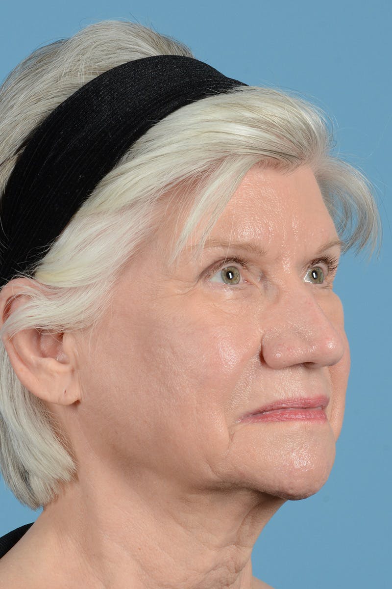 Facial Augmentation Before & After Gallery - Patient 291977 - Image 3