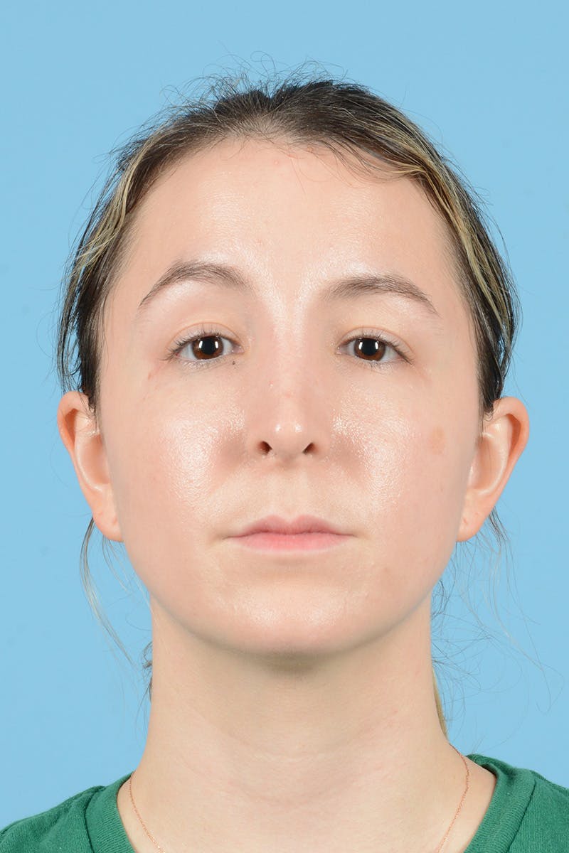 Rhinoplasty Before & After Gallery - Patient 356875 - Image 2