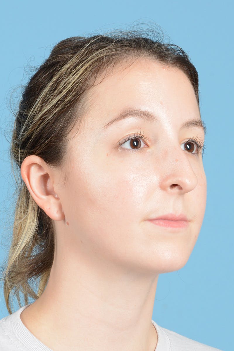 Rhinoplasty Before & After Gallery - Patient 356875 - Image 3