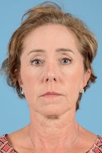 Facelift Before & After Gallery - Patient 289758 - Image 1