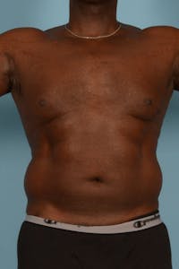 Liposuction Before & After Gallery - Patient 227470 - Image 1