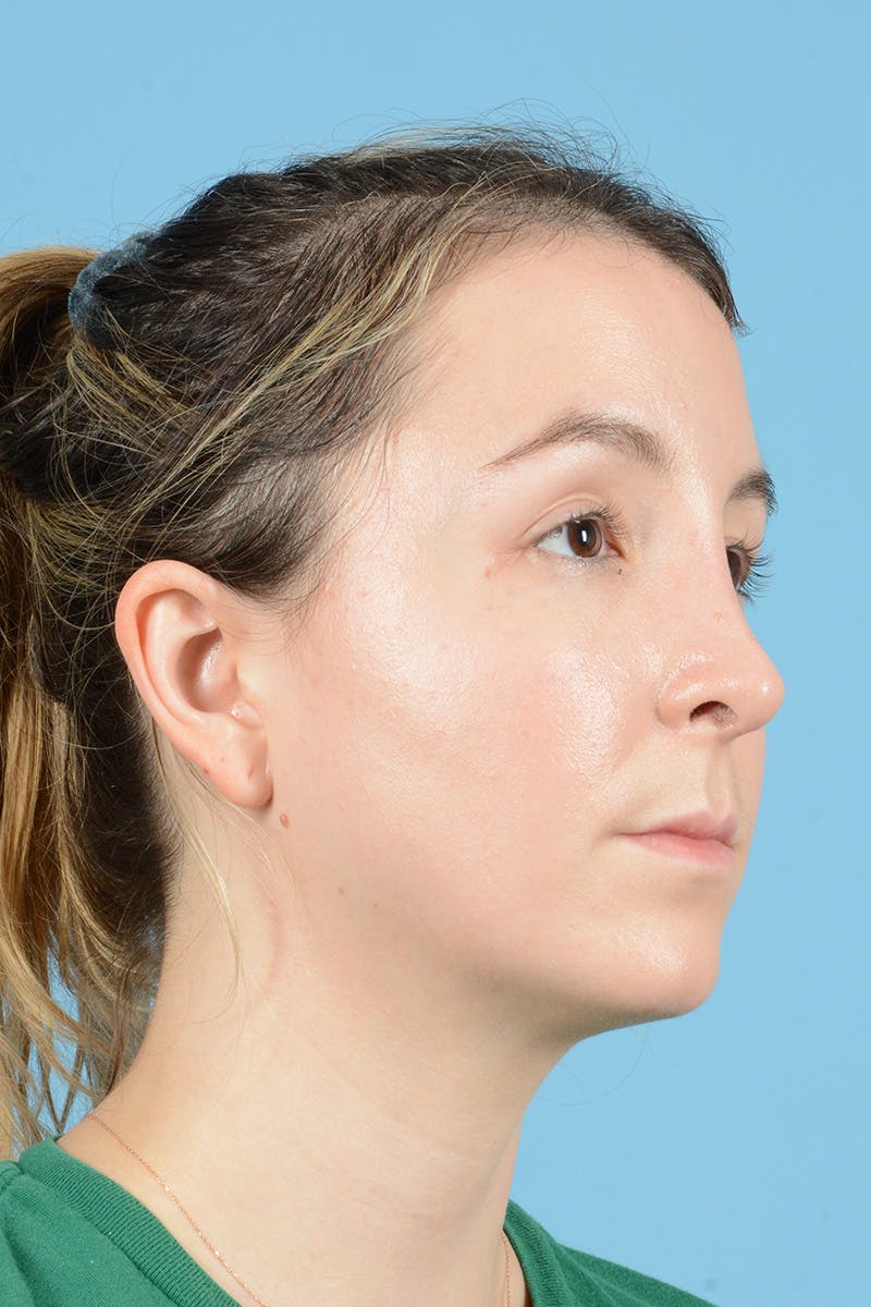 Rhinoplasty Before & After Gallery - Patient 356875 - Image 4
