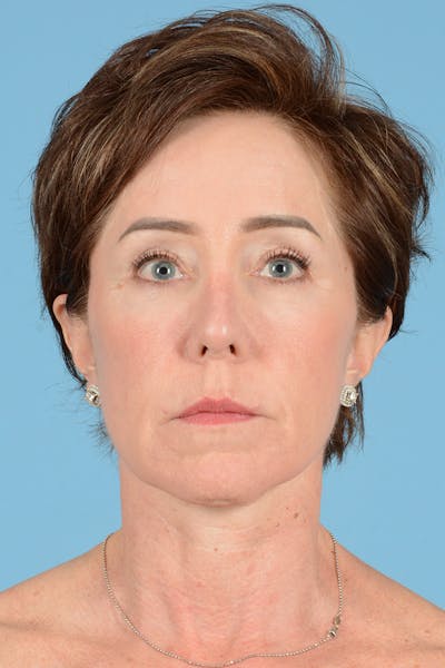 Facelift Before & After Gallery - Patient 289758 - Image 2