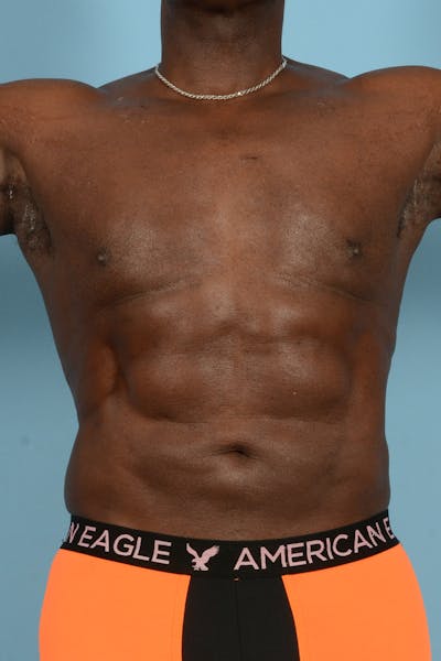 Liposuction Before & After Gallery - Patient 227470 - Image 2