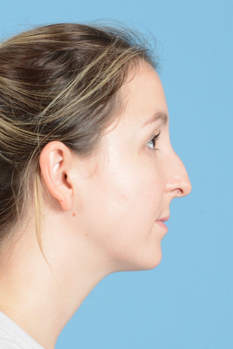 Rhinoplasty Before & After Gallery - Patient 356875 - Image 5