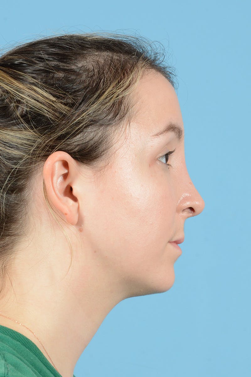 Rhinoplasty Before & After Gallery - Patient 356875 - Image 6