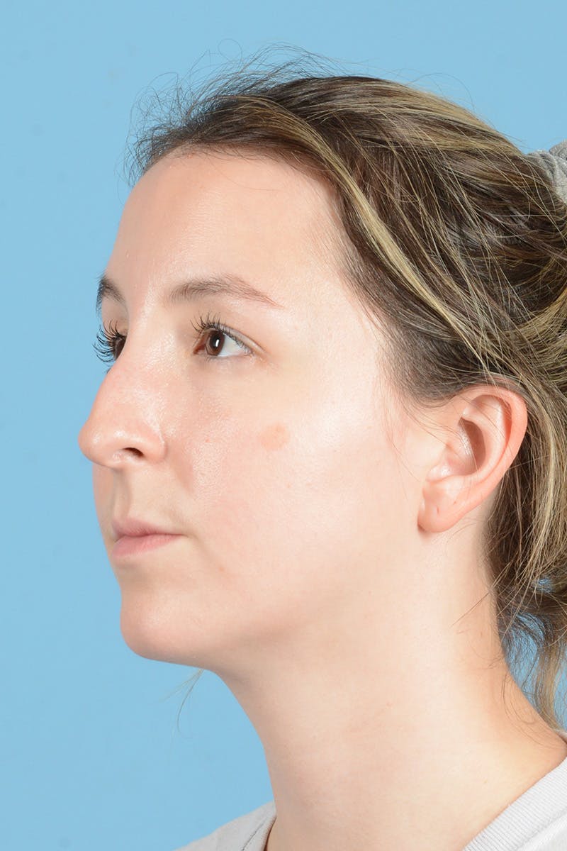 Rhinoplasty Before & After Gallery - Patient 356875 - Image 7