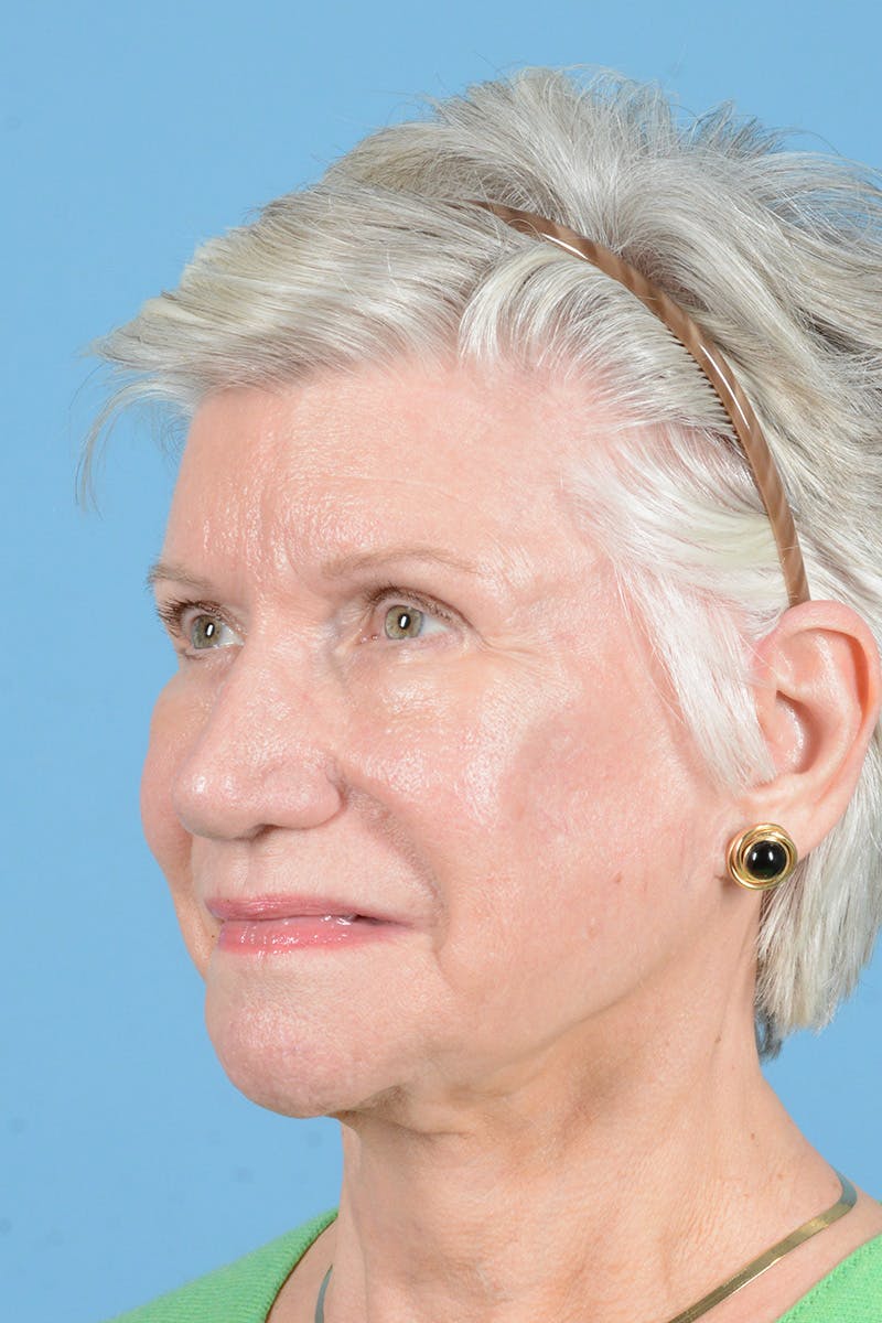Facial Augmentation Before & After Gallery - Patient 291977 - Image 8