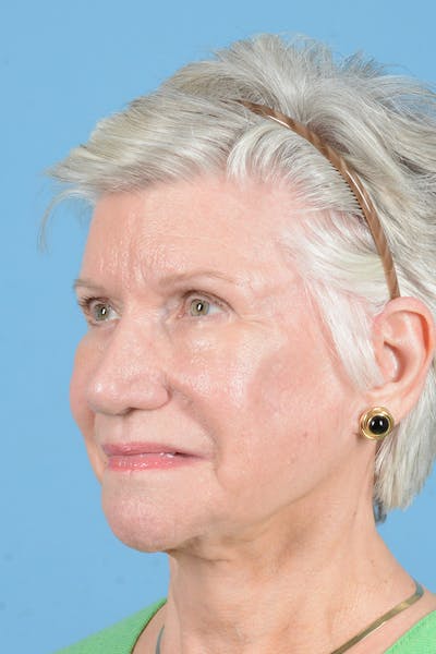 Facial Augmentation Before & After Gallery - Patient 291977 - Image 8