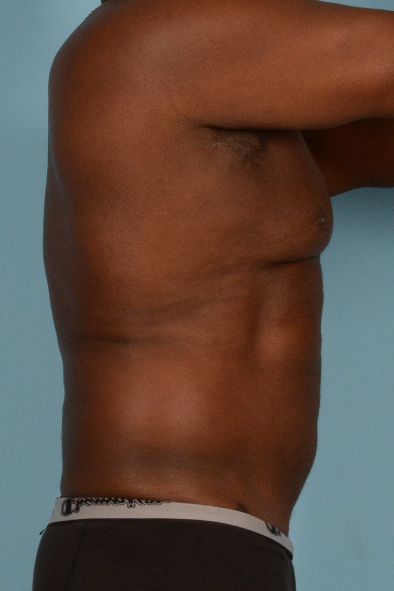 Liposuction Before & After Gallery - Patient 227470 - Image 5