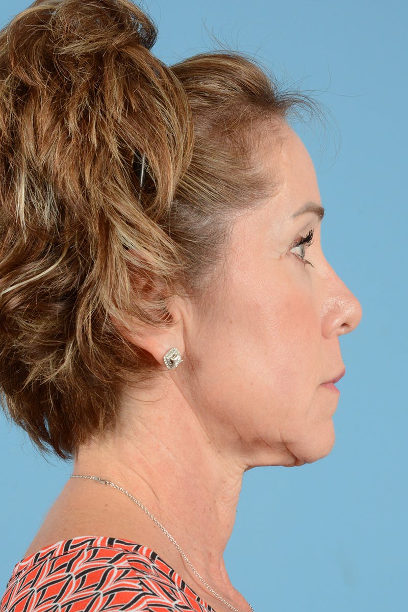 Facelift Before & After Gallery - Patient 289758 - Image 5