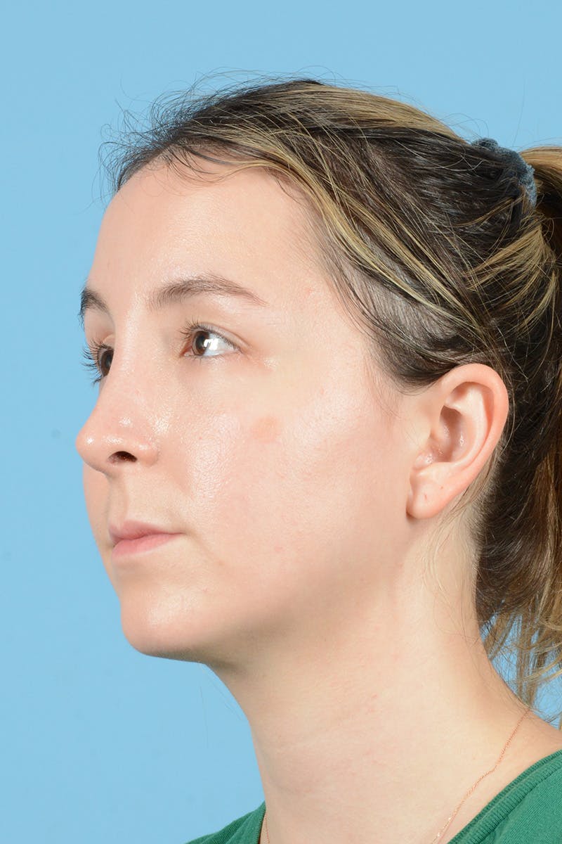 Rhinoplasty Before & After Gallery - Patient 356875 - Image 8
