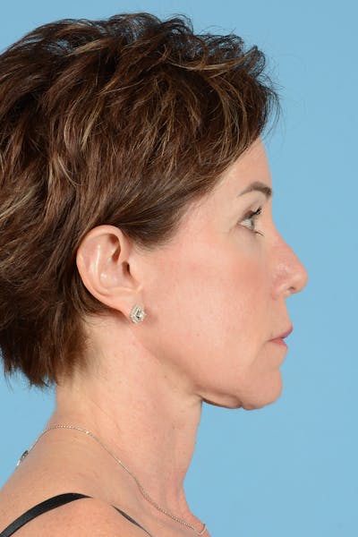 Facelift Before & After Gallery - Patient 289758 - Image 6