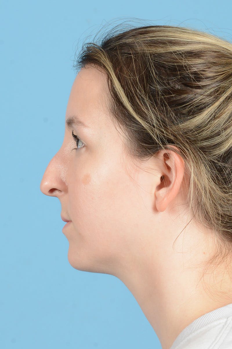 Rhinoplasty Before & After Gallery - Patient 356875 - Image 9