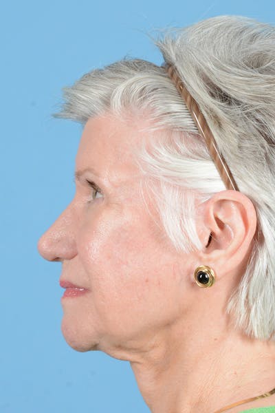 Facial Augmentation Before & After Gallery - Patient 291977 - Image 10