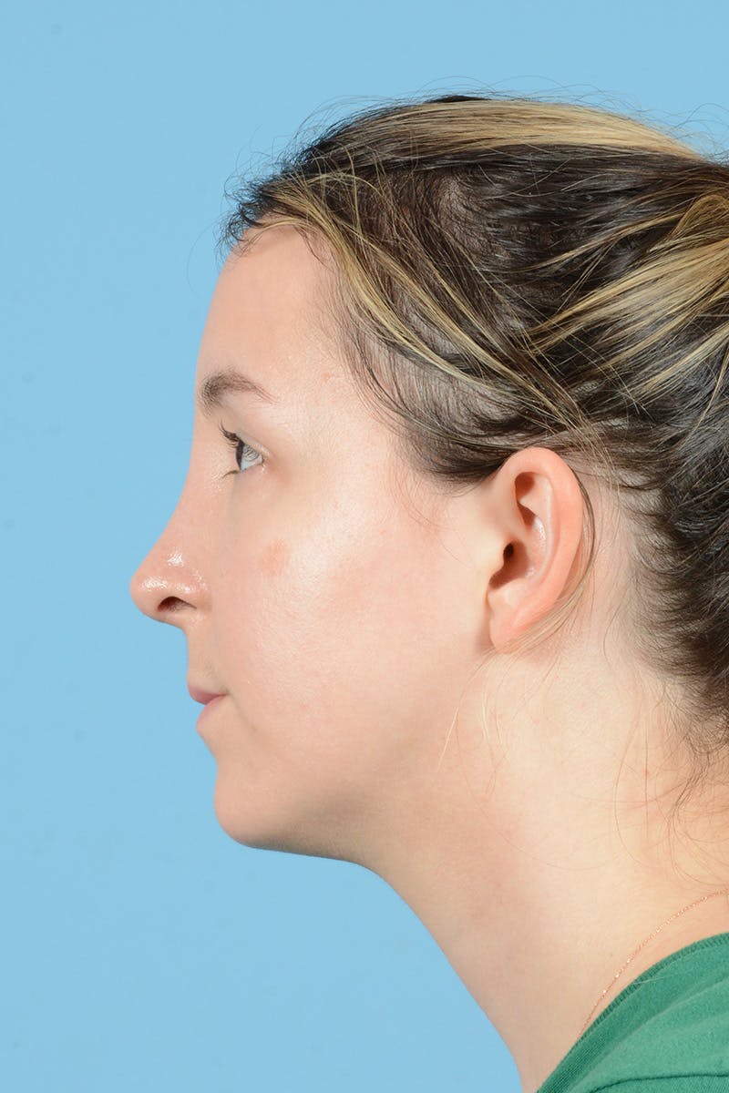 Rhinoplasty Before & After Gallery - Patient 356875 - Image 10