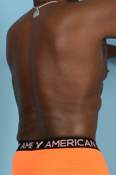 Liposuction Before & After Gallery - Patient 227470 - Image 8