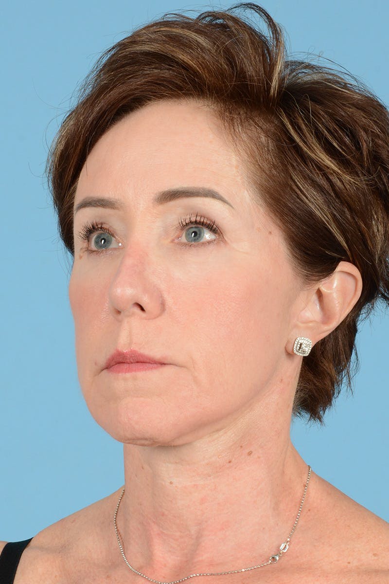 Facelift Before & After Gallery - Patient 289758 - Image 8