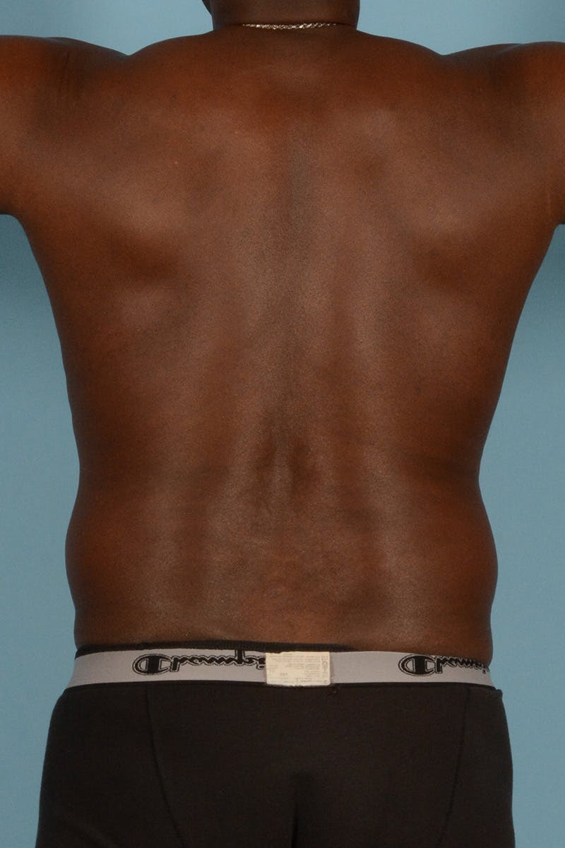 Liposuction Before & After Gallery - Patient 227470 - Image 9