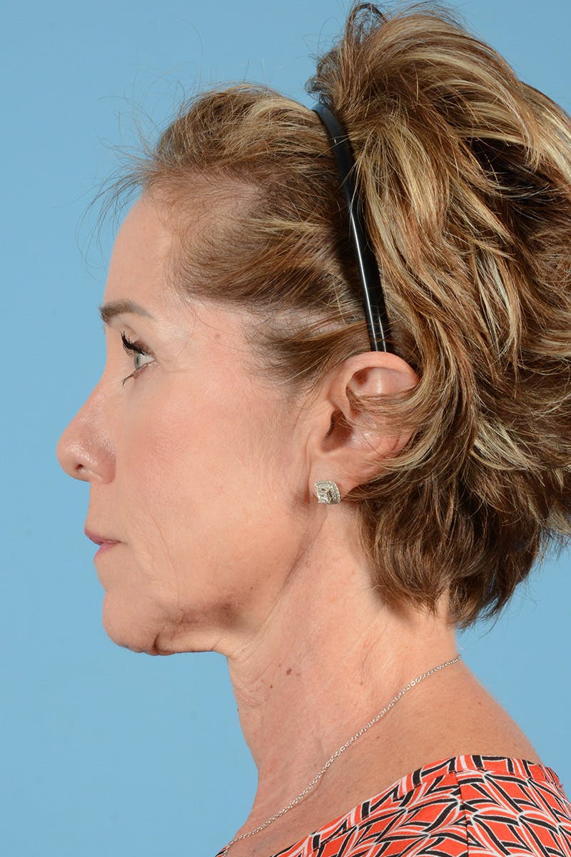Facelift Before & After Gallery - Patient 289758 - Image 9