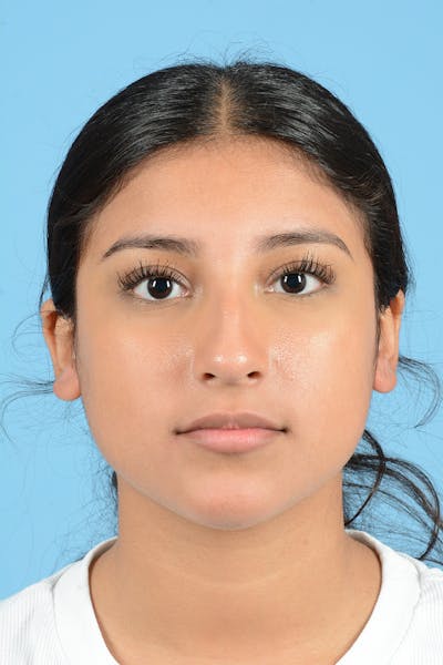 Rhinoplasty Before & After Gallery - Patient 779015 - Image 1
