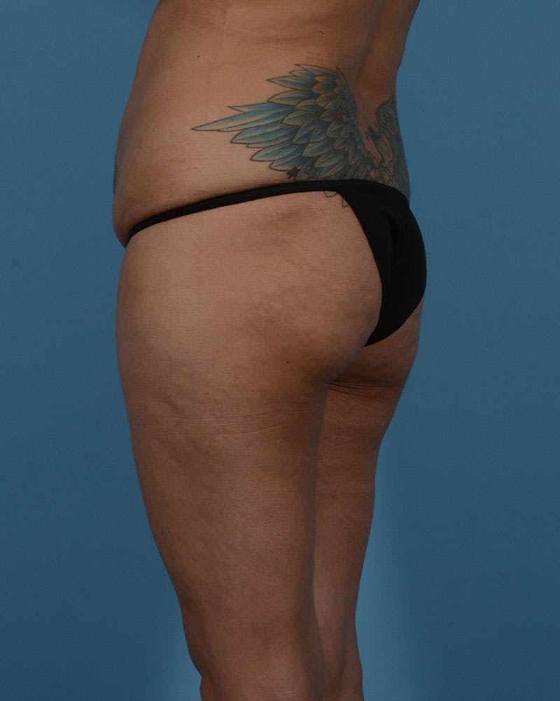 Mommy Makeover Before & After Gallery - Patient 192022 - Image 13