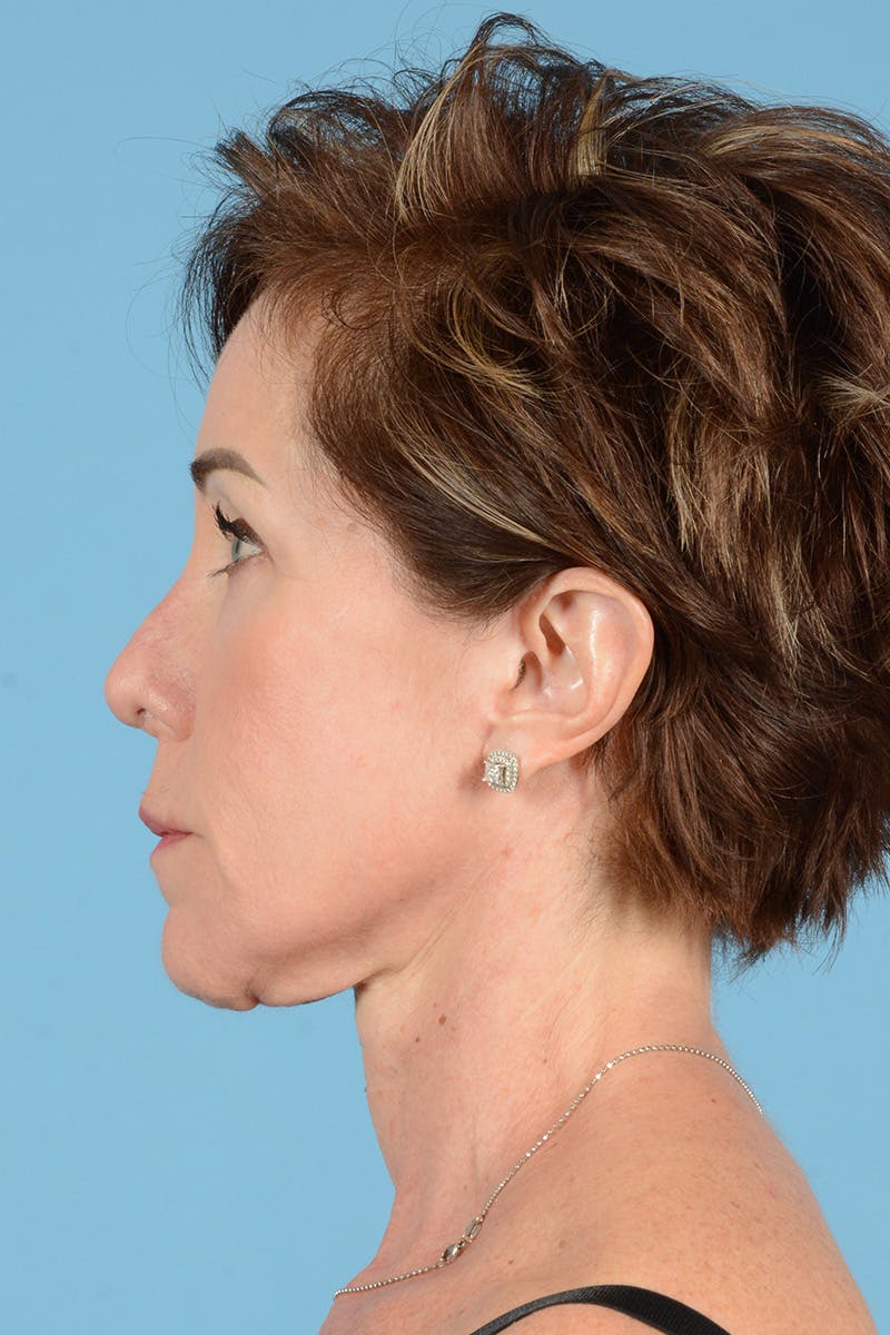 Facelift Before & After Gallery - Patient 289758 - Image 10