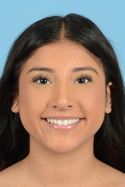 Rhinoplasty Before & After Gallery - Patient 779015 - Image 2