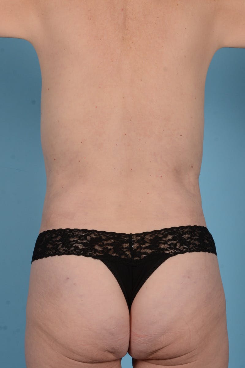 Tummy Tuck Before & After Gallery - Patient 353152 - Image 8