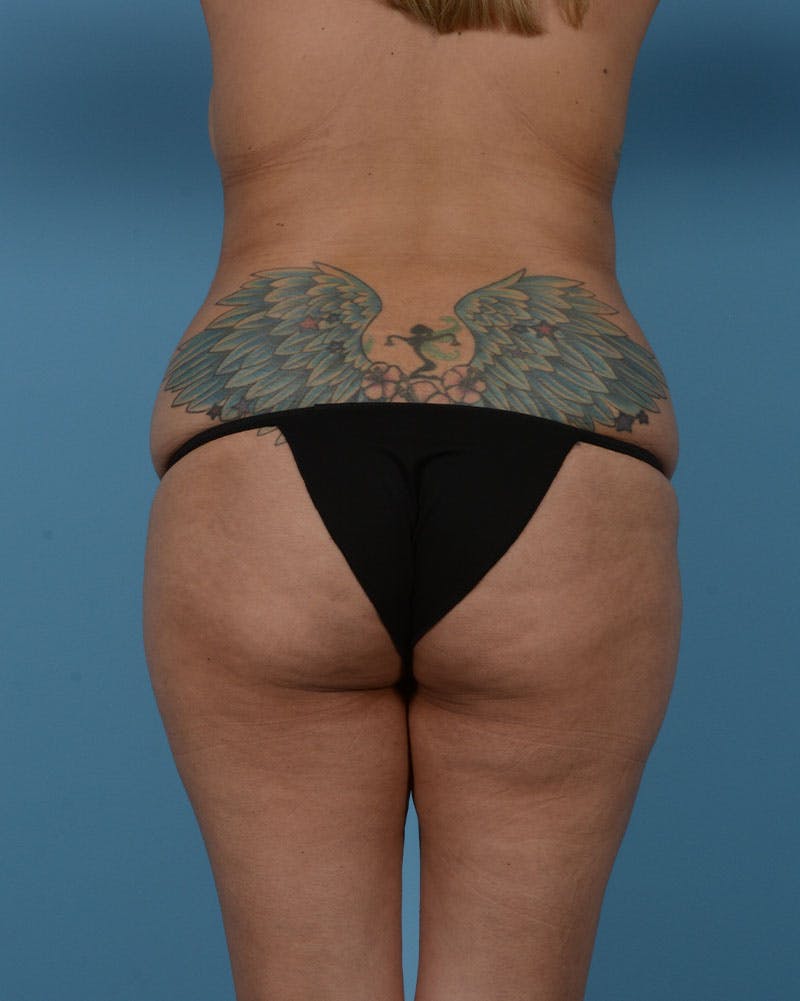 Mommy Makeover Before & After Gallery - Patient 192022 - Image 15