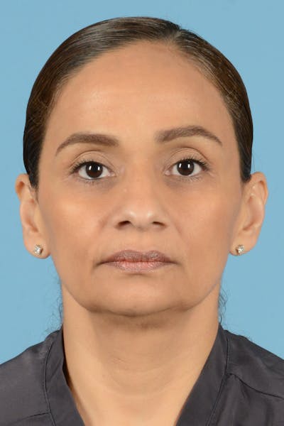 Facelift Before & After Gallery - Patient 399960 - Image 1