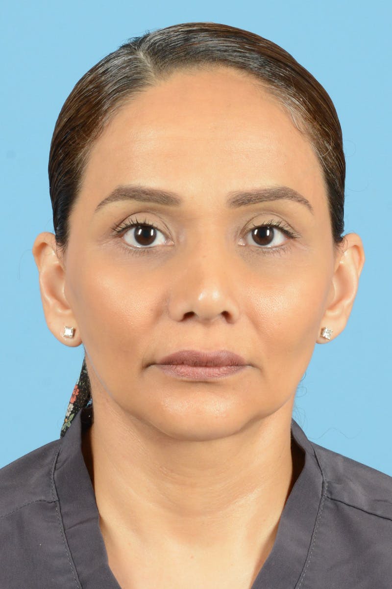 Facelift Before & After Gallery - Patient 399960 - Image 2