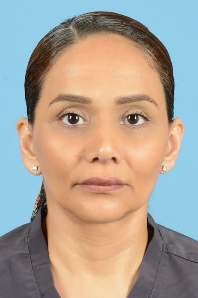 Facelift Before & After Gallery - Patient 399960 - Image 2