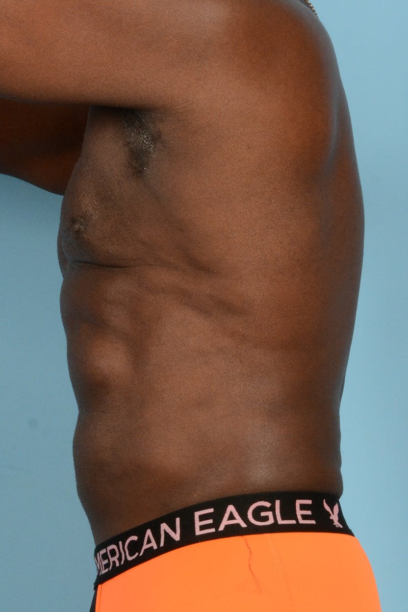Liposuction Before & After Gallery - Patient 227470 - Image 14