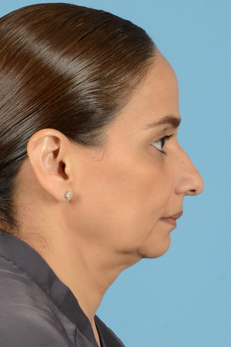 Facelift Before & After Gallery - Patient 399960 - Image 5
