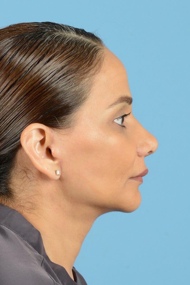Facelift Before & After Gallery - Patient 399960 - Image 6