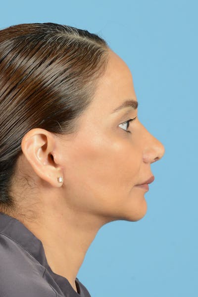 Facelift Before & After Gallery - Patient 399960 - Image 6