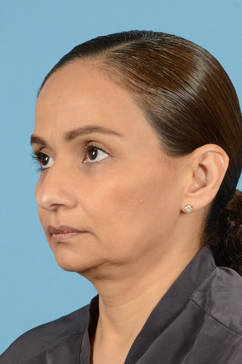 Facelift Before & After Gallery - Patient 399960 - Image 7
