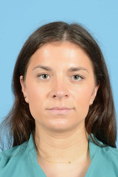 Rhinoplasty Before & After Gallery - Patient 380529 - Image 2